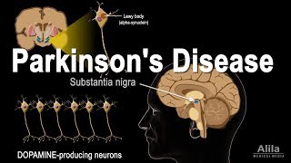 Parkinsons Disease Animation [upl. by Rovert]