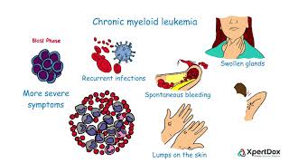 Acute Myeloid Leukemia and New Paths to Treatment [upl. by Shem]