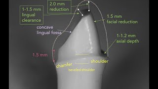 Anterior PFM Preparation  Dr Richard Stevenson [upl. by Francene]