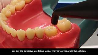 3M™ RelyX™ Ultimate Adhesive Resin Cement Application Video [upl. by Meier]