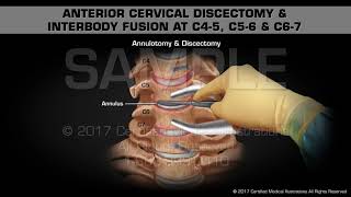 Herniated Disc Causes Signs and Symptoms Diagnosis and Treatment [upl. by Salomo]