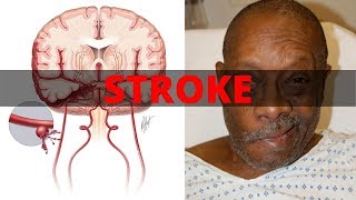 Swallowing and Communication after Stroke [upl. by Mona]