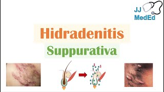 Hidradenitis Suppurativa HS  Pathophysiology Triggers Signs amp Symptoms Diagnosis Treatment [upl. by Laehplar313]