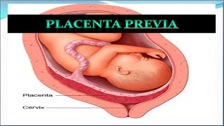 Placenta Previa Update [upl. by Korns111]