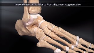 Lisfranc and Bifurcate Ligaments MRI Anatomy [upl. by Trixie166]