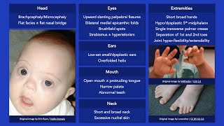 Down Syndrome Dysmorphic Features [upl. by Letnahs]