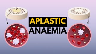 Aplastic Anaemia Causes Signs and Symptoms Diagnosis and Treatment [upl. by Seidnac]