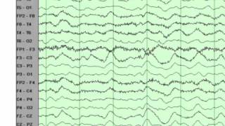 EEG basics [upl. by Mcgaw568]