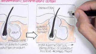 Acne Pathophsyiology [upl. by Taryn]