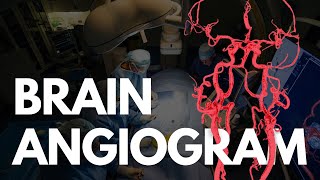 THE LATEST TECHNOLOGY IN CORONARY ANGIOGRAM AND PCI  DIAMONDBACK PROCEDURE [upl. by Nylad813]