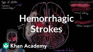 Hemorrhage bleeding Causes Signs and Symptoms Diagnosis and Treatment [upl. by Gawain]