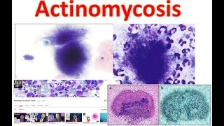 Actinomycosis Medschooltutorial [upl. by Lohse]