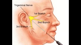 Trigeminal Neuralgia [upl. by Notsur]