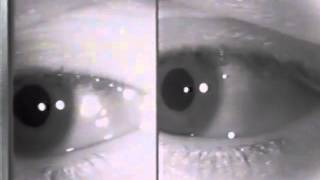 Physiologic EndGaze Nystagmus [upl. by Pierpont]