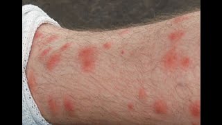 HOW TO  Get Rid of Chigger Bites and Stop Itching Naturally [upl. by Attaynek366]