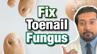 How to Treat Toenail Fungus CORRECTLY  Easy Steps 2021 [upl. by Nivre]