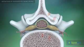 Osteophytes bone spurs Definition [upl. by Eniale]