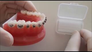 Comment mettre de la cire orthodontique [upl. by Ditzel104]