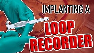 Loop Recorder Implant Procedure [upl. by Skees]