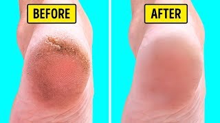 10 Natural Home Remedies for Silky Smooth Feet [upl. by Naamann]