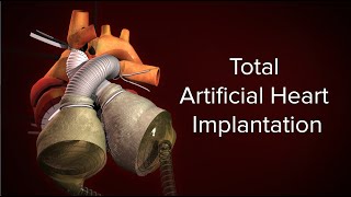 Medical Animation Total Artificial Heart Implantation  Cincinnati Childrens [upl. by Aicad379]