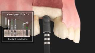 Astra Tech Implant System  TX 40S installation standard protocol [upl. by Munniks742]