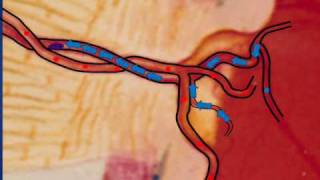 What is Central Retinal Vein Occlusion CRVO [upl. by Rohclem]