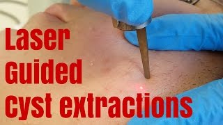 Extracting blind blackheads with lasers [upl. by Aliber]