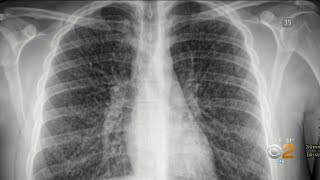 Interstitial Lung Disease ILD in a Nutshell [upl. by Kcira]