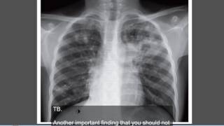 Tuberculosis Active TB  Chest x ray [upl. by Intirb]