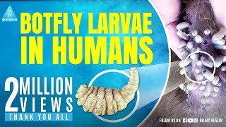 botfly larvae in humans [upl. by Ttezzil]