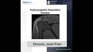 Hydroxyapatite Deposition Disease [upl. by Robinette]