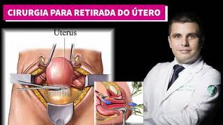 Histerectomia  A cirurgia para retirada do útero [upl. by Enyrehtak]