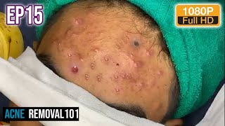 Cystic Acne Extraction 20mn  Acne treatment by ACNEREMOVAL101 [upl. by Vic]