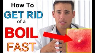 How to get RID of a Boil FAST at Home 3 STEPS  Quickest Way to GET RID of a BOIL [upl. by Calandra]