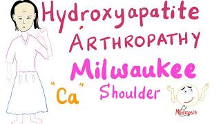 Hydroxyapatite Arthropathy  Milwaukee Shoulder  Rheumatology [upl. by Powel461]