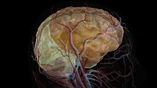 Hemorrhagic stroke epidural amp subdural hematoma  USMLE Step 1 [upl. by Reece]