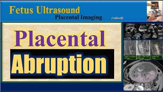 Fetus Ultrasound  Placental Abruption [upl. by Aderfla]