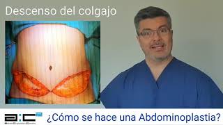 ¿Cómo se hace una Abdominoplastia [upl. by Eislel]