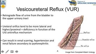 vesicoureteric reflux [upl. by Ecylahs]