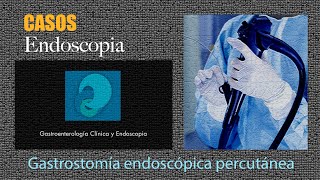 Gastrostomia endoscópica percutánea [upl. by Ydospahr939]