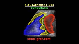 Sonografie  Pleuraerguss links [upl. by Joseito431]