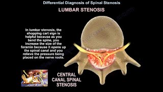 Foraminal Stenosis Problems and Treatments Part 2 [upl. by Merrow]