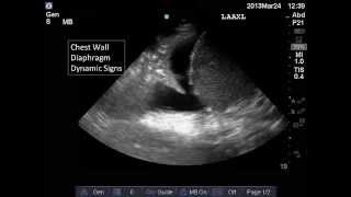 Lung and Pleural Ultrasound Interpretation [upl. by Edwin]