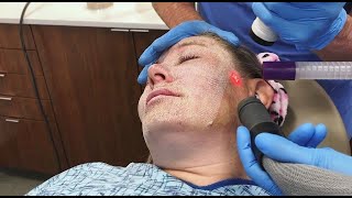 Full Face Fractional CO2 Laser Resurfacing for Wrinkles and Skin Tightening [upl. by Alfredo]