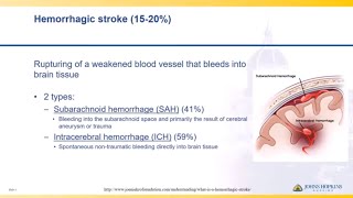 Hemorrhagic Stroke Recovery  Week 3 [upl. by Llenrod174]