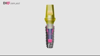 Indexing Dental Implant Abutments Correctly [upl. by Yreffej271]