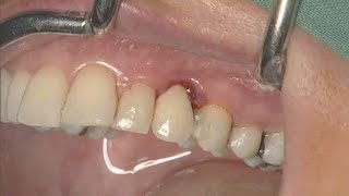 NobelActive clinical case immediate implant placement  Eric Rompen [upl. by Eisele]