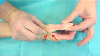 Entorse grave du pouce testing  Thumb instability [upl. by Ddot]