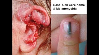 Basal Cell Carcinoma amp Melanonychia Nail Lines Updated [upl. by Also]